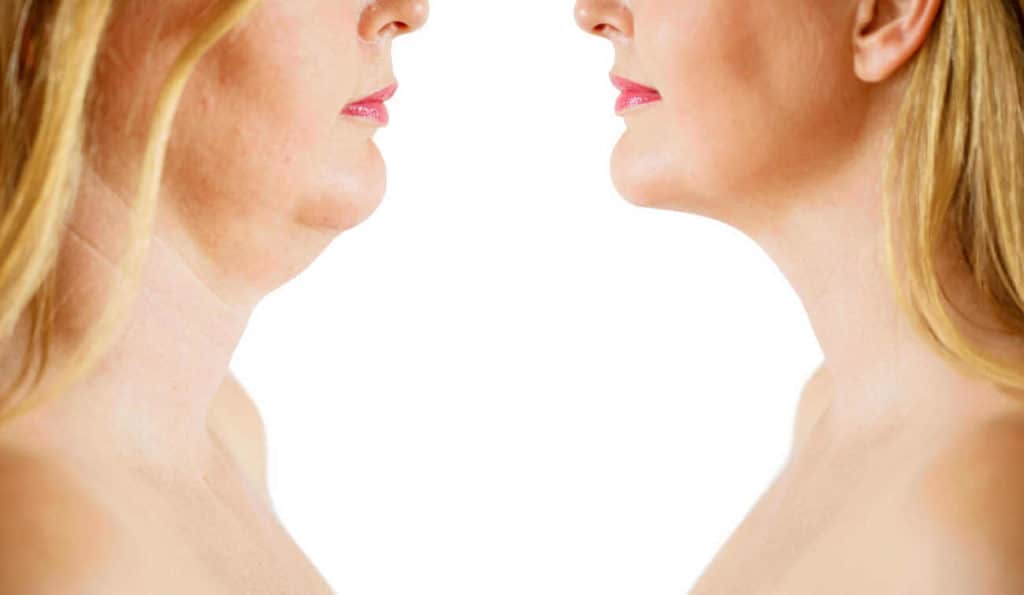 Double Chin treatment Fulham before and after results