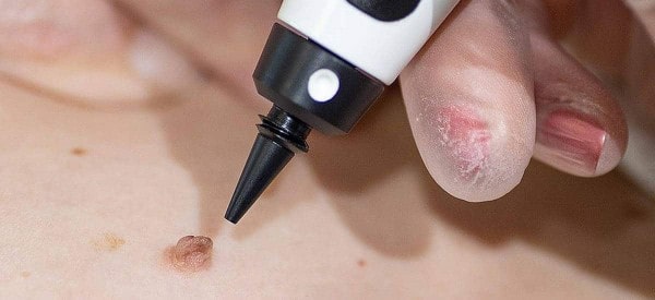 After Skin Tag Removal Fulham