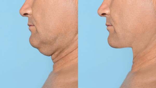 Which Non-Surgical Treatments Work Best for Jowls and Loose Skin Fulham?