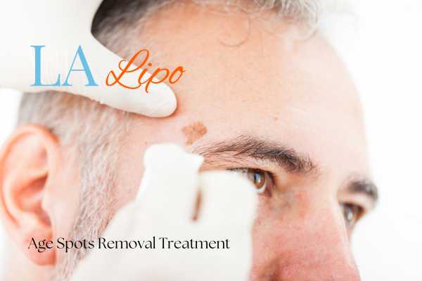 What Are the Most Effective Treatments for Age Spots Fulham?