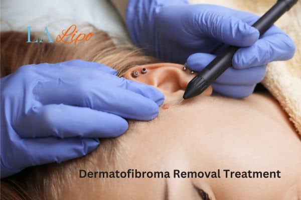 Dermatofibroma Removal Treatment Fulham