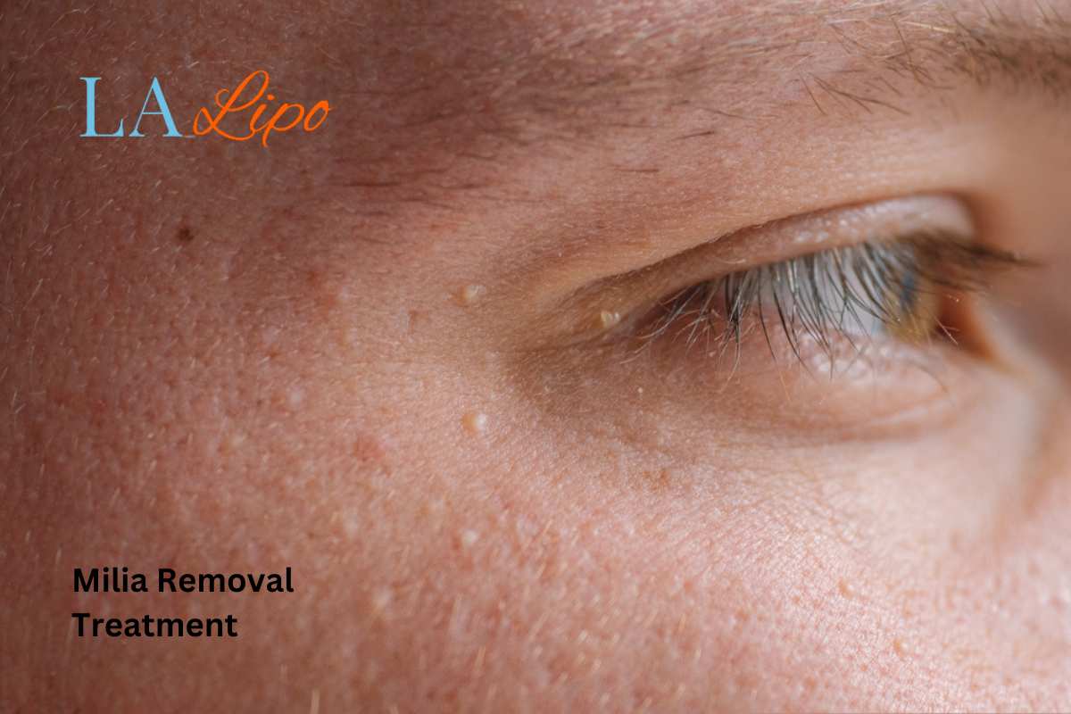 Cryopen Milia Removal: Is It the Easiest and Safest Option Fulham?