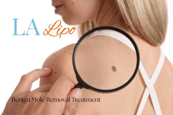 Woman having her inspection of blemish before mole removal Fulham