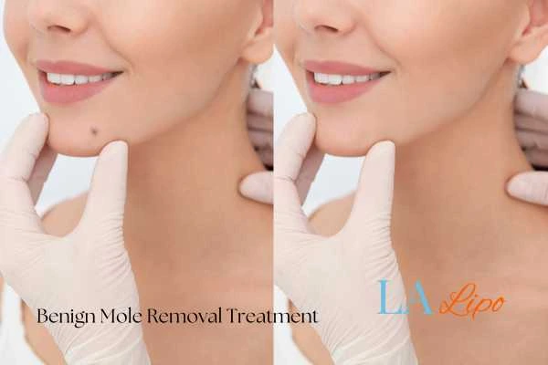 woman's before and after mole removal Fulham results