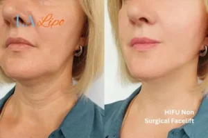 hi-fu for wrinkles Fulham before and after results