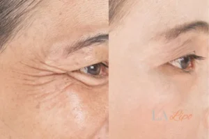 Before and after results of woman - HI-fu wrinkles reduction treatment Fulham
