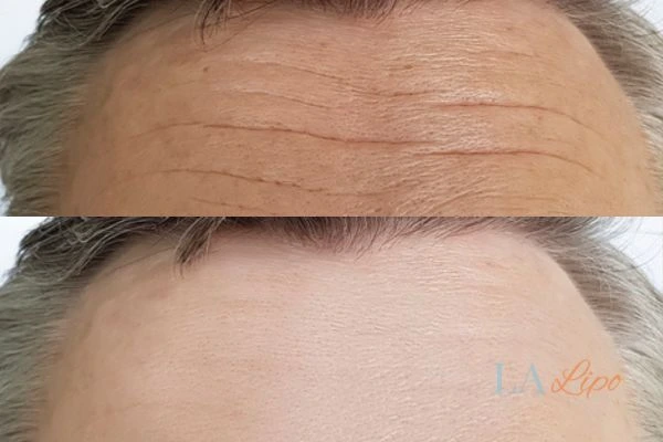 results of HIFU Fulham on mans forehead to help reduce lines and wrinkles