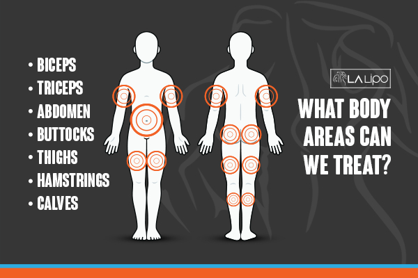 Graphic to show areas you can have LA-EMS Body Sculpting Fulham treatment.