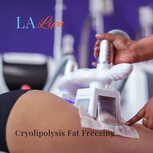 fat freezing - Cryolipolysis Fulham