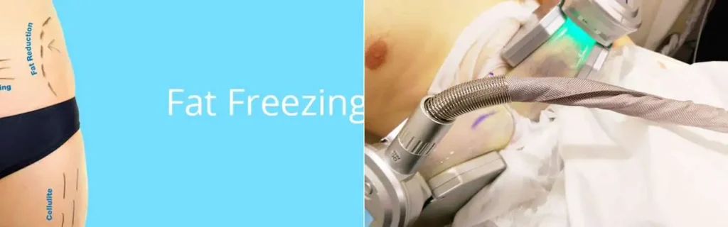 multi areas of a persons body having coolsculpting Fulham treatment