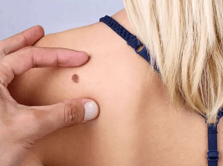 woman having mole removal Fulham consultation before treatment.
