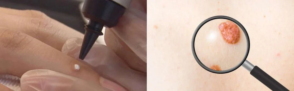 Person getting moles removed with cryopen Fulham