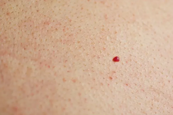 close up of a cherry angioma Fulham