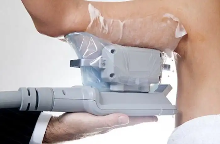 Picture of fat freezing Fulham on the upper arms.