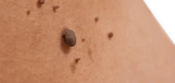 image of a skin tag Fulham