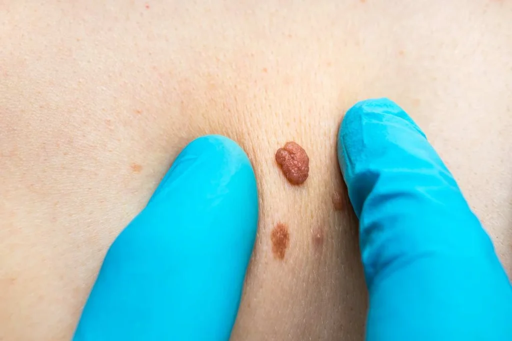 Consultant examining a skin tag Fulham