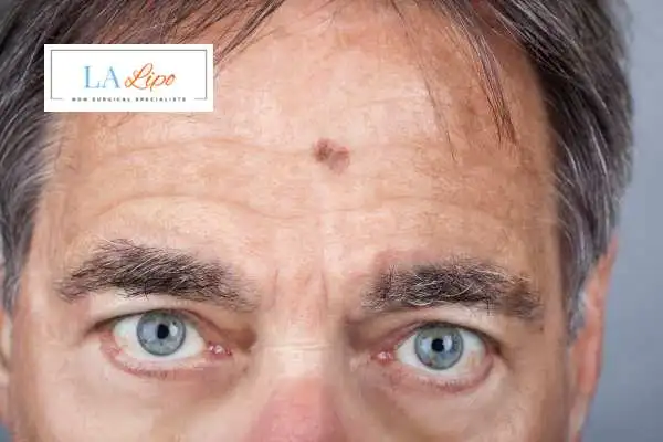 Solar Lentigo Removal Fulham image of man with mark on his forehead
