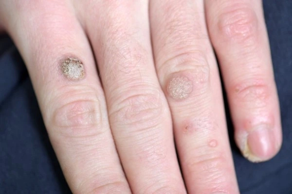 photo of warts on person hand - see wart removal Fulham from LA LIPO