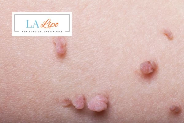Does cryopen skin tag removal Fulham hurt? Find out now call our team today!