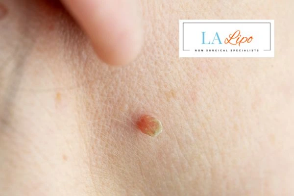 Book skin tag removal Fulham today speak to our team now!