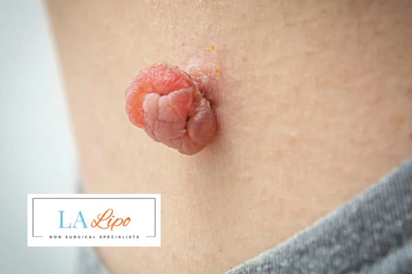 Interested in skin tag removal Fulham? Concerned about the pain? Find out more today!