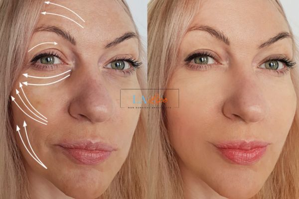 Morpheus 8 results Fulham face lift.