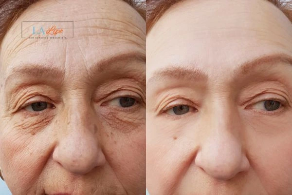The powerful benefits of Morpheus8 Treatment Fulham - Call Our team today!