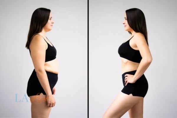 Picture of womans before and after using LA-EMS body sculpting to improve her core strength Fulham