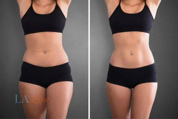 before and after results of non-surgical treatment to help a woman's body image and mental health Fulham