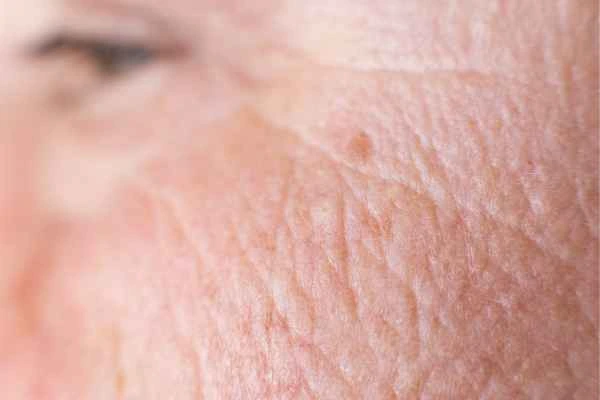 close up picture of a woman's face showing an age spot Fulham