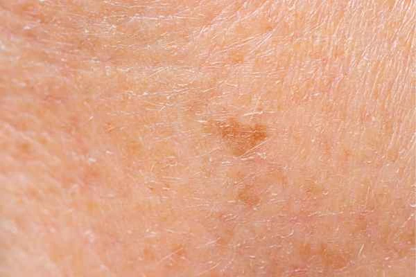 close up picture of age spots Fulham