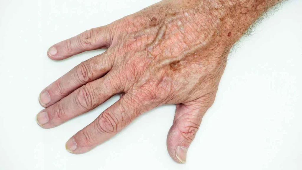 Male hand showing age spot Fulham