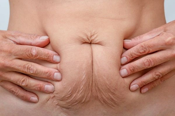 Image of a woman's stomach with loose skin - example of skin tightening Fulham options