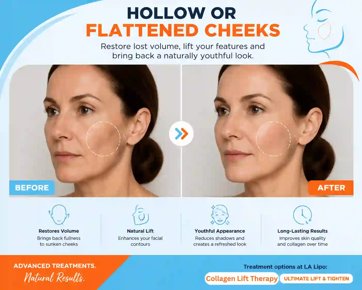 Sign #4: Hollow or Flattened Cheeks Fulham