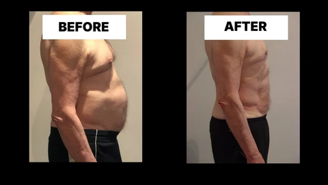 What Symptoms Can Diastasis Recti Cause in Men? Weak Core, Back Pain and Poor Posture Fulham